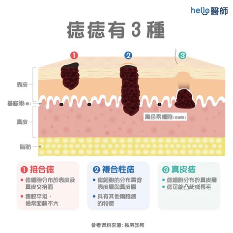 左青龍客廳 痣形成的原因